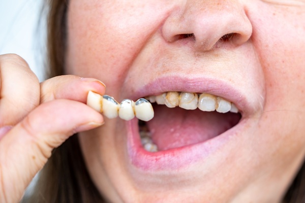 A Snapshot Of The Four Types Of Dental Bridges